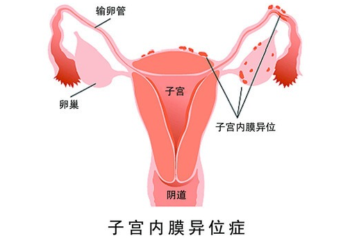 孕妇在怀孕期间使用屈孕酮片