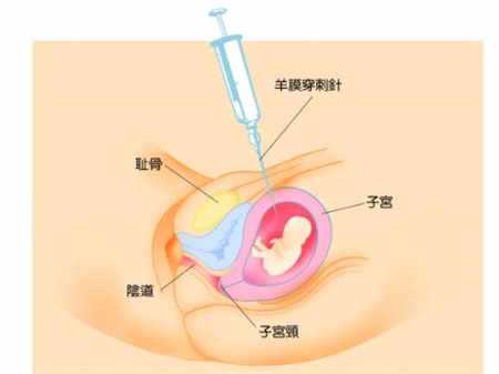 代孕期身体出现这6种疼痛，说明代孕胎儿发育很