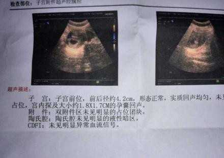广州世纪代怀孕公司靠谱：单位体检查出甲状腺
